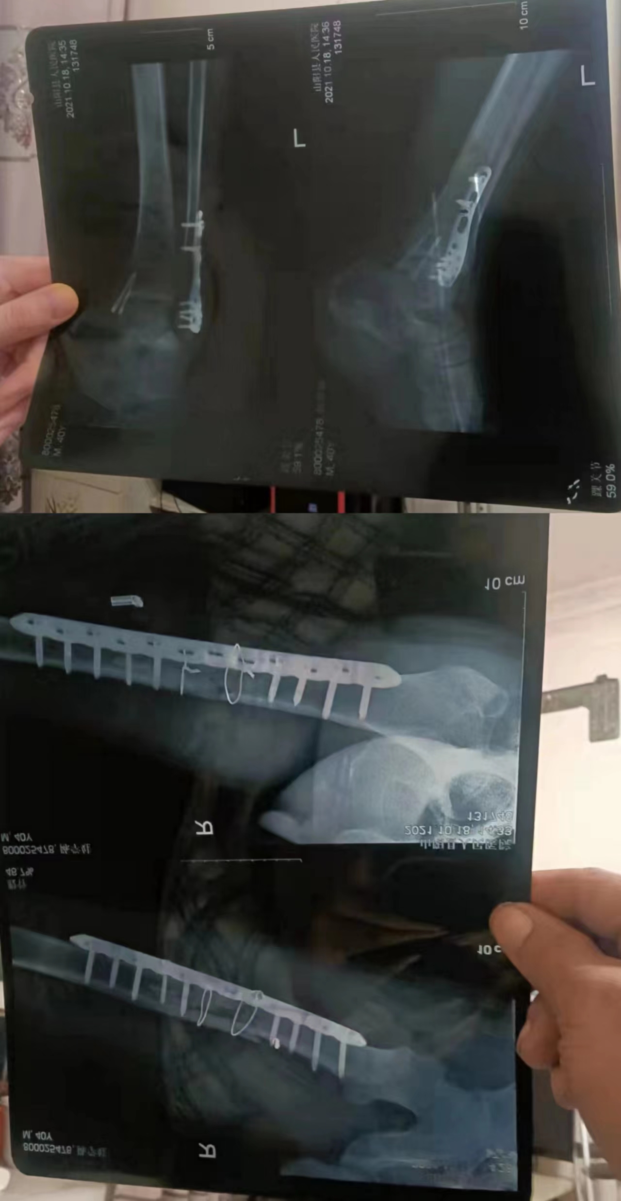 复查左踝关节和右股骨X光.jpg